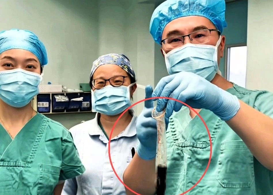 Chinese doctors remove a cigarette lighter swallowed 30 years ago using a condom after forceps failed as the patient finally sought help for pain revealing the bizarre long hidden object.