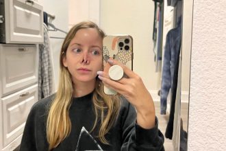 Woman rebuilds confidence after dog bite as surgeons craft new nose from her forehead - sharing her journey of healing, resilience, and hope through 16 surgeries.