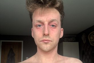 Former athlete left housebound by topical steroid withdrawal shares his three year battle with burning oozing skin and crippling pain as he fights to recover and raise awareness.