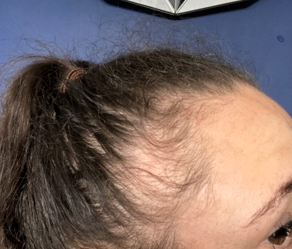 Charmaine Hines' hair loss while using weight loss jabs