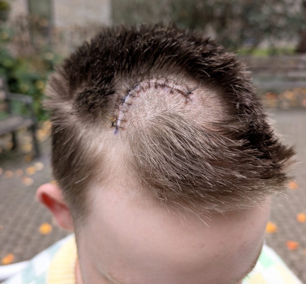 Mum saves son’s life after doctors dismiss brain tumour symptoms as exam stress. Optician visit leads to shock diagnosis and life-saving surgery for 16-year-old Jamie.