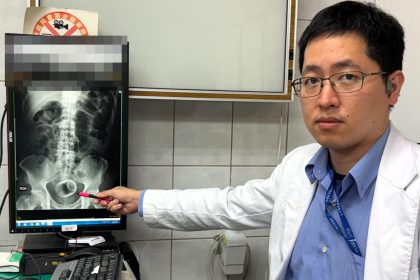 Dr Wu Kunda pointing at The X-ray revealed a ceramic cup upside down in his rectum