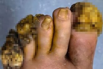 A woman’s decade long battle with severe verrucas caused by lupus left her foot deformed until surgeons removed the clustered warts and performed a skin graft restoring her mobility and quality of life.