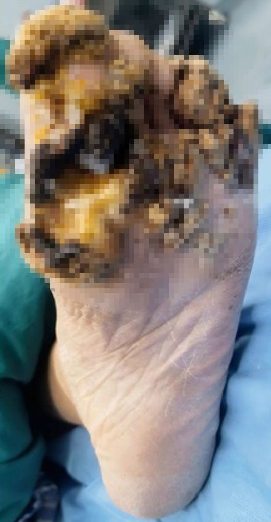 A woman’s decade long battle with severe verrucas caused by lupus left her foot deformed until surgeons removed the clustered warts and performed a skin graft restoring her mobility and quality of life.
