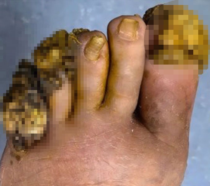 A woman’s decade long battle with severe verrucas caused by lupus left her foot deformed until surgeons removed the clustered warts and performed a skin graft restoring her mobility and quality of life.