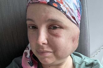 Hillary before tumour remova surgery