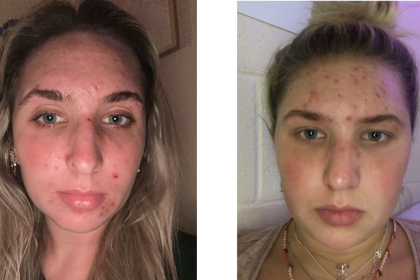 A woman with dermatillomania spends hours nightly picking her skin until it bleeds, leaving deep scars and emotional pain, but therapy is helping her break free from the cycle.