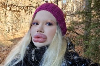 A woman with the world’s biggest lips has spent £20,000 on fillers and been blacklisted by 30 doctors but refuses to stop her extreme lip enhancements.