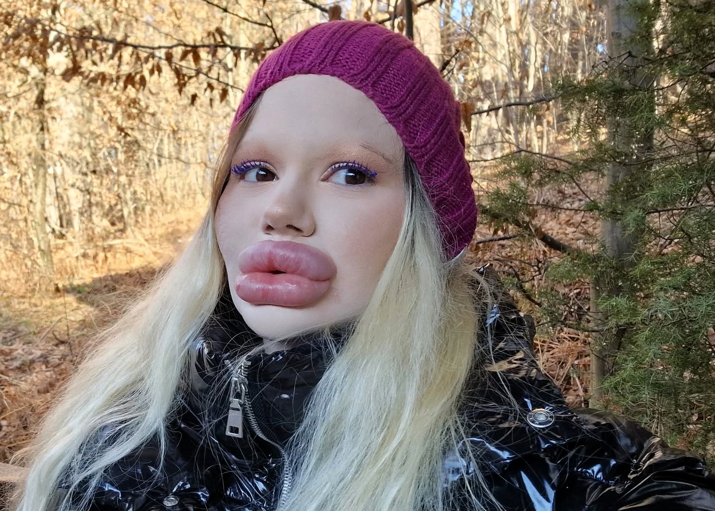 A woman with the world’s biggest lips has spent £20,000 on fillers and been blacklisted by 30 doctors but refuses to stop her extreme lip enhancements.
