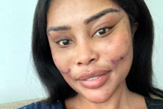 Model Jade Mandongwe spends 50000 on a facelift before 30 sharing her transformation journey highlighting beauty pressures and why feeling refreshed was worth it.