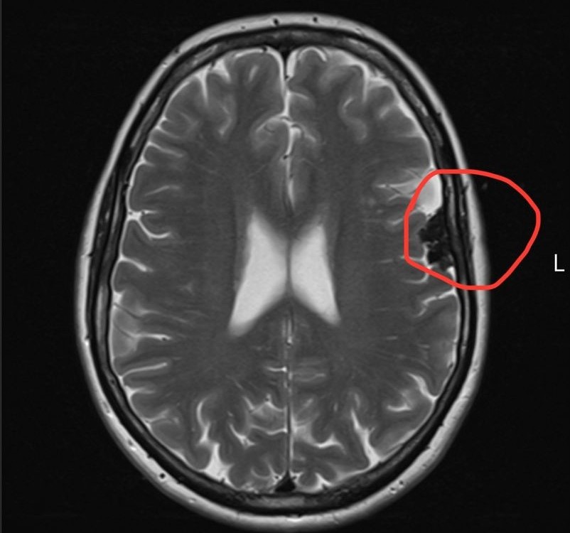 A woman who thought her stuttering and typing issues were menopause symptoms was shocked to discover two brain tumours - now she’s raising awareness with a 99-mile challenge. A woman who thought her stuttering and typing issues were menopause symptoms was shocked to discover two brain tumours - now she’s raising awareness with a 99-mile challenge.