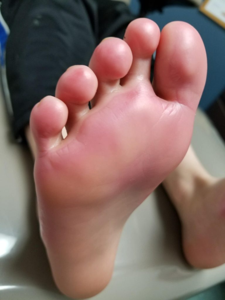 Mum warns parents before Christmas after light up shoes leaked battery acid on her sons feet, causing second degree burns and lasting nerve damage after getting wet at school.