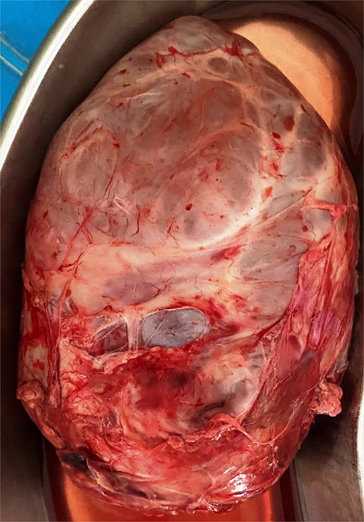 Doctors baffled as baby found with bread sized 550g lump in stomach rare neuroglial heterotopia removed in surgery infant recovers and thrives after mystery mass case.
