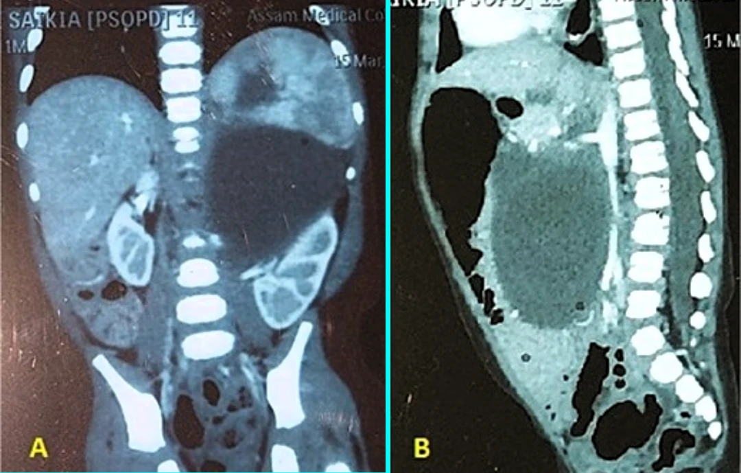 Doctors baffled as baby found with bread sized 550g lump in stomach rare neuroglial heterotopia removed in surgery infant recovers and thrives after mystery mass case.