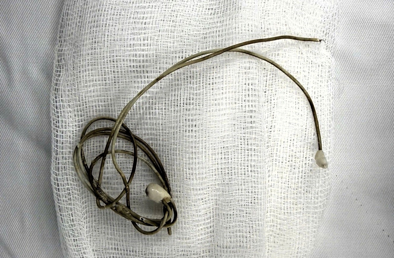 Teen undergoes surgery after inserting a phone charger into his bladder inspiring a gripping story of danger medical urgency and online risks with a full recovery.