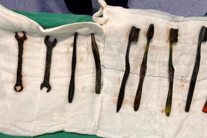 Doctors removed seven toothbrushes and two spanners from a man's stomach after he suffered chronic abdominal pain, with the objects lodged there for weeks before requiring two-hour emergency surgery.