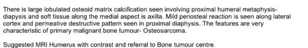 Young woman learns she has rare bone cancer after reading tumour results on NHS app- a shocking diagnosis that changed her life and fuels calls for patient communication.