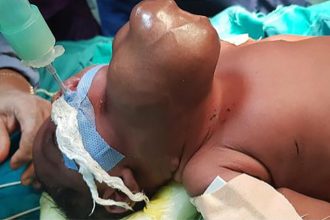 A newborn with a rare 15x20cm neck tumour was successfully treated after doctors removed the immature teratoma and thyroid gland, one of only 1 in 40,000 cases worldwide.