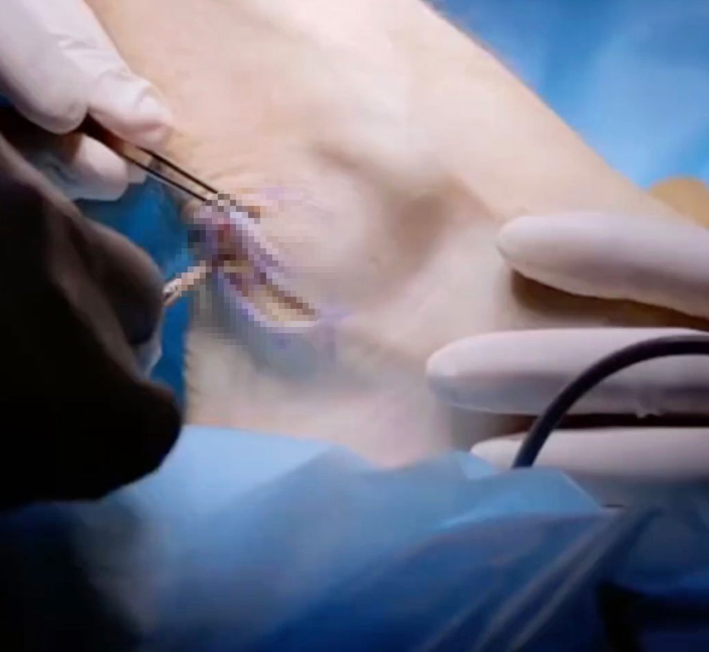 After a factory accident tore off her ear a woman had it kept alive on her foot using a rare grafting procedure before surgeons successfully replanted it months later in an emotional recovery.