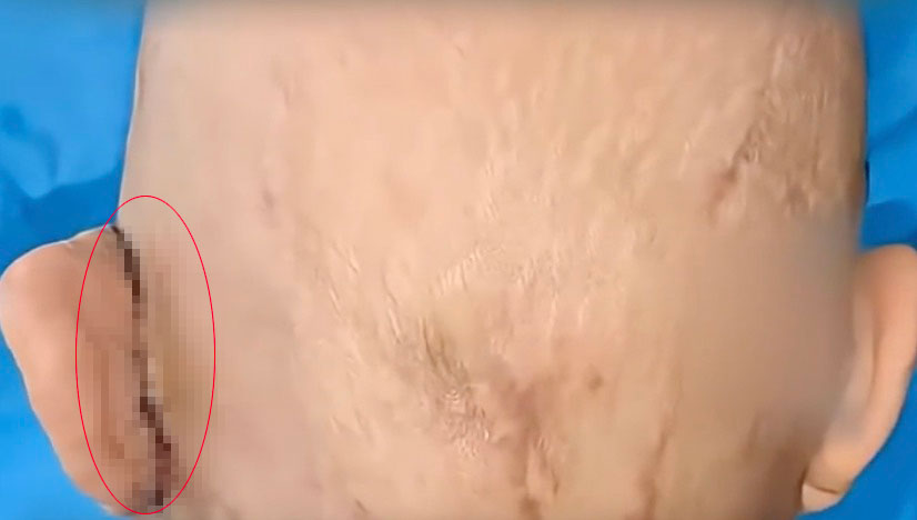 After a factory accident tore off her ear a woman had it kept alive on her foot using a rare grafting procedure before surgeons successfully replanted it months later in an emotional recovery.