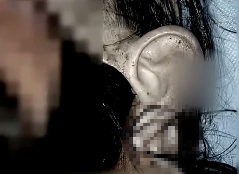 After a factory accident tore off her ear a woman had it kept alive on her foot using a rare grafting procedure before surgeons successfully replanted it months later in an emotional recovery.