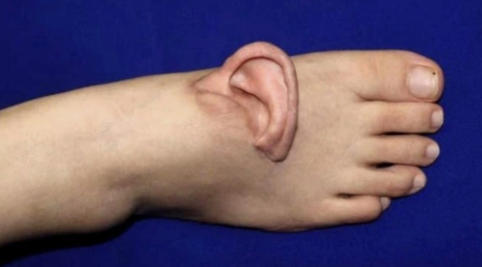 After a factory accident tore off her ear a woman had it kept alive on her foot using a rare grafting procedure before surgeons successfully replanted it months later in an emotional recovery.