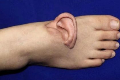 After a factory accident tore off her ear a woman had it kept alive on her foot using a rare grafting procedure before surgeons successfully replanted it months later in an emotional recovery.