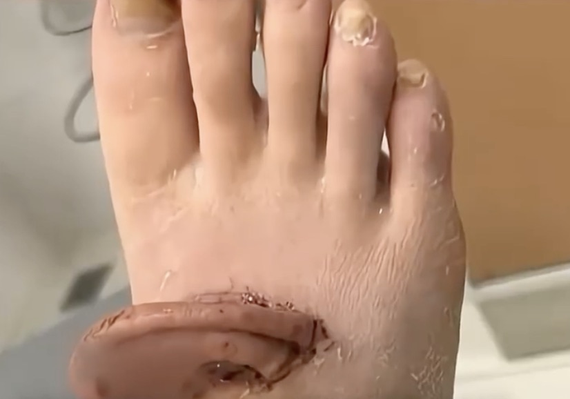 After a factory accident tore off her ear a woman had it kept alive on her foot using a rare grafting procedure before surgeons successfully replanted it months later in an emotional recovery.