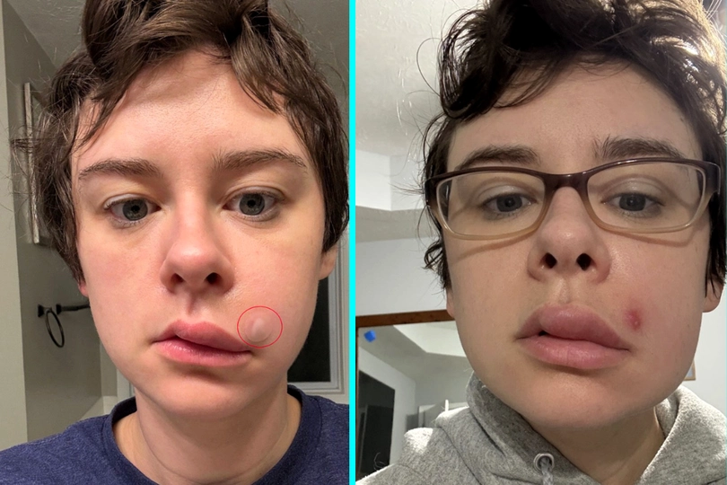 Woman warns against popping pimples in triangle of death after blemish caused facial paralysis and serious infection highlighting hidden dangers of common skincare mistakes.