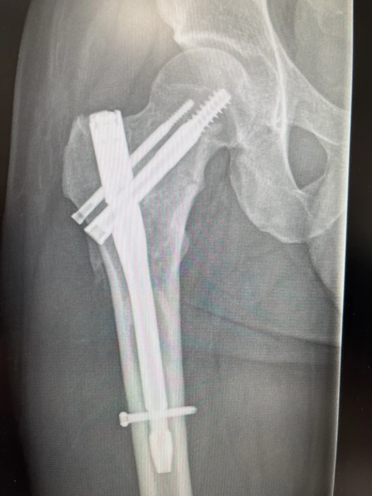 Man diagnosed with rare bone condition after cancer scare rebuilds life learns to walk then runs ultras with titanium rod proving grit resilience and gratitude every mile.