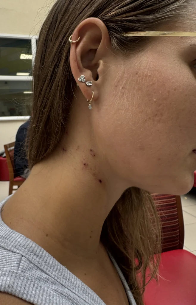 London woman hospitalised with severe stomach pain reveals hormone tablets triggered a rare blood disorder, leaving her fighting for life and raising health awareness.