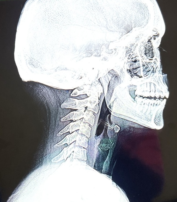 Teacher Shelli Gunnoe fights years of dismissed symptoms to uncover a Chiari malformation causing her brain to press downward while she continues teaching and chasing big goals.