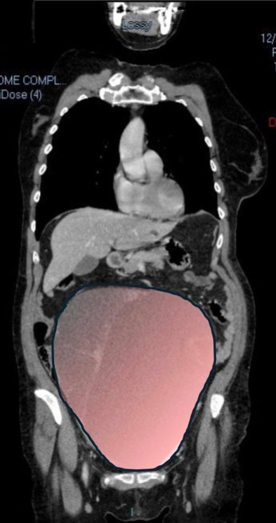 Surgeons removed a 28cm ovarian tumour weighing 6kg, the size of a full-term baby, from a 69-year-old woman in Turin after it caused severe bowel obstruction.