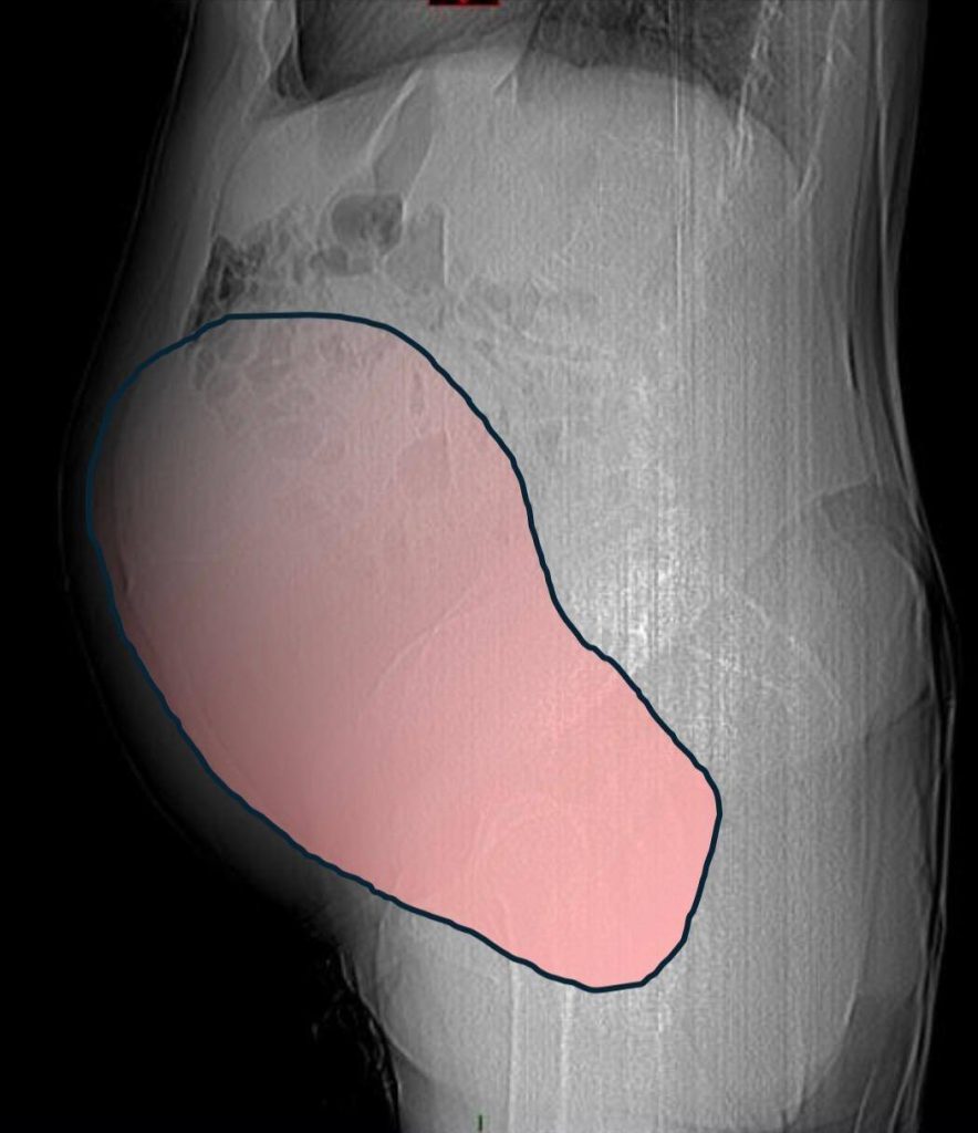 Surgeons removed a 28cm ovarian tumour weighing 6kg, the size of a full-term baby, from a 69-year-old woman in Turin after it caused severe bowel obstruction.
