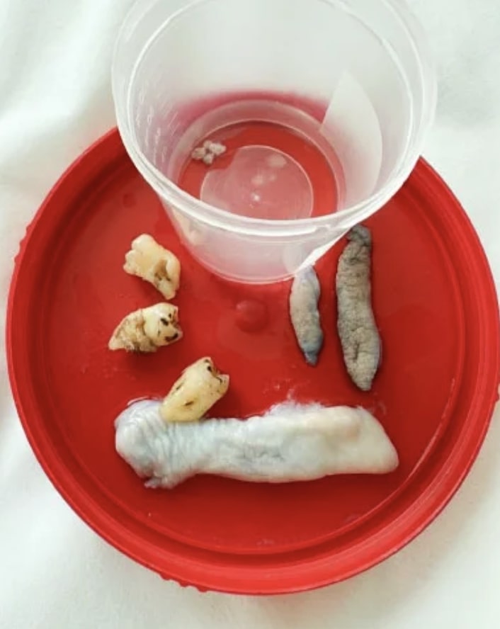 Model Tracy Kiss, 38, from Buckinghamshire spent £25,500 on labiaplasty, vaginoplasty and stress incontinence surgery in Turkey, saying she feels like a woman reborn after reversing childbirth effects.