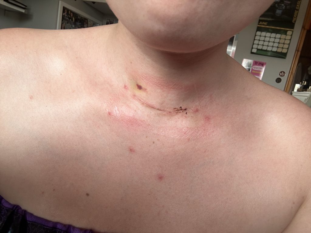 Woman reveals ordeal after being fobbed off by doctors who said her excruciating pain was normal. Hannah Sheridan's life is now on the line after thyroid cancer diagnosis.