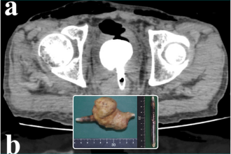 Man in his 60s died from sepsis after eyeliner with giant 6.5cm bladder stone attached was found lodged inside his rectum during post-mortem - it had pierced his bladder.