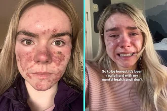 A former beauty queen says cystic acne left her hiding behind face masks and dreading leaving the house - and warns that her Accutane treatment has been a "double-edged sword" for her mental health.