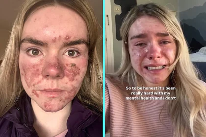 A former beauty queen says cystic acne left her hiding behind face masks and dreading leaving the house - and warns that her Accutane treatment has been a "double-edged sword" for her mental health.