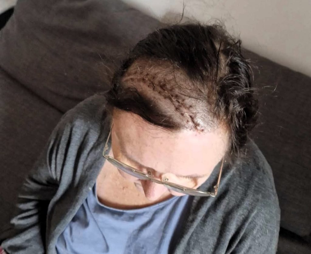 Mother develops orange-sized brain tumor after 25 years on contraceptive jab. Minna Lotsari lost years of memories and can't recall grandchildren's births.