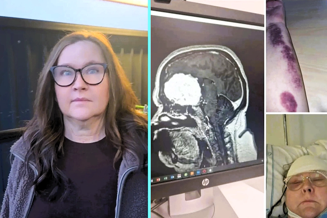 Mother develops orange-sized brain tumor after 25 years on contraceptive jab. Minna Lotsari lost years of memories and can't recall grandchildren's births.