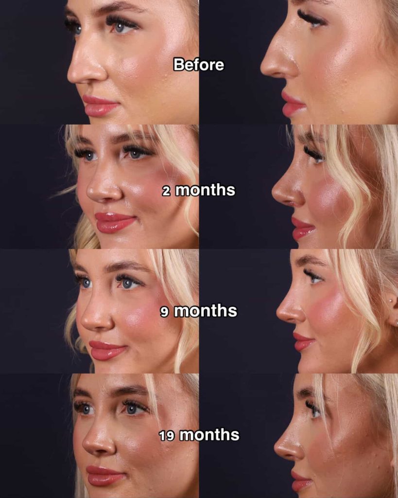 A London woman spent 23 years unable to breathe properly after UK doctors failed to spot a 60% airway blockage - so she flew to Turkey for a life-changing nose job that fixed everything.