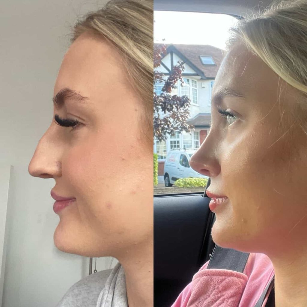 A London woman spent 23 years unable to breathe properly after UK doctors failed to spot a 60% airway blockage - so she flew to Turkey for a life-changing nose job that fixed everything.