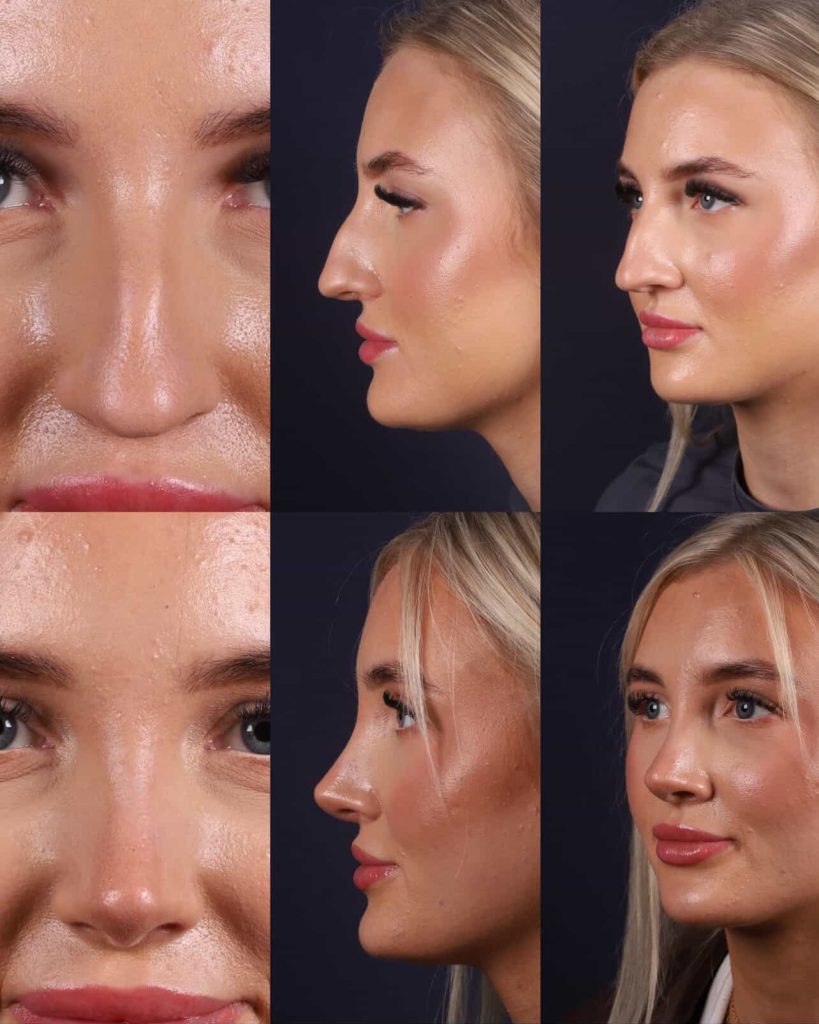 A London woman spent 23 years unable to breathe properly after UK doctors failed to spot a 60% airway blockage - so she flew to Turkey for a life-changing nose job that fixed everything.