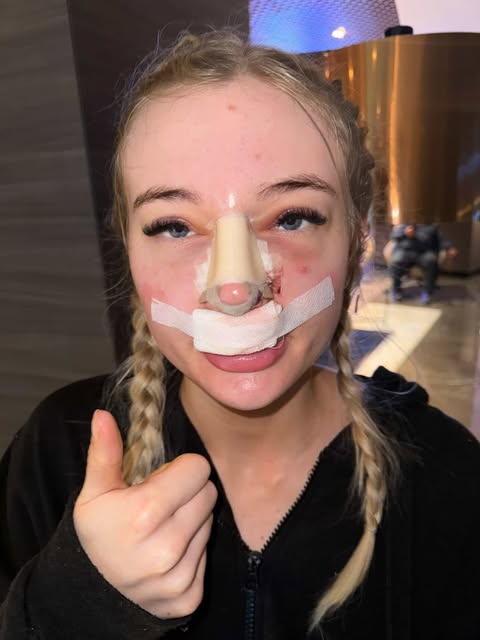 A London woman spent 23 years unable to breathe properly after UK doctors failed to spot a 60% airway blockage - so she flew to Turkey for a life-changing nose job that fixed everything.