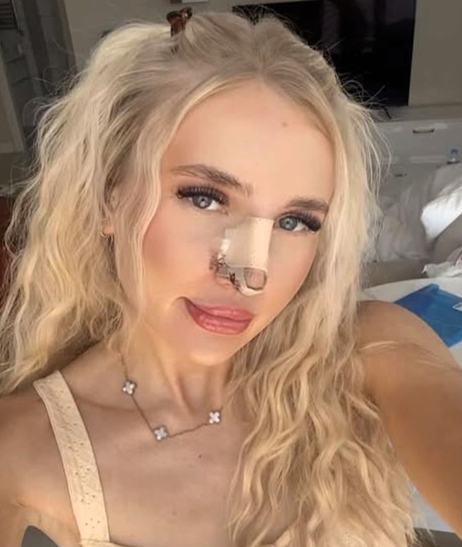 A London woman spent 23 years unable to breathe properly after UK doctors failed to spot a 60% airway blockage - so she flew to Turkey for a life-changing nose job that fixed everything.