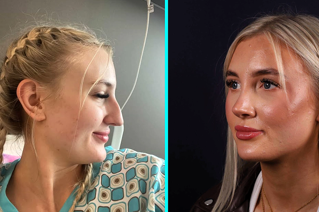 A London woman spent 23 years unable to breathe properly after UK doctors failed to spot a 60% airway blockage - so she flew to Turkey for a life-changing nose job that fixed everything.