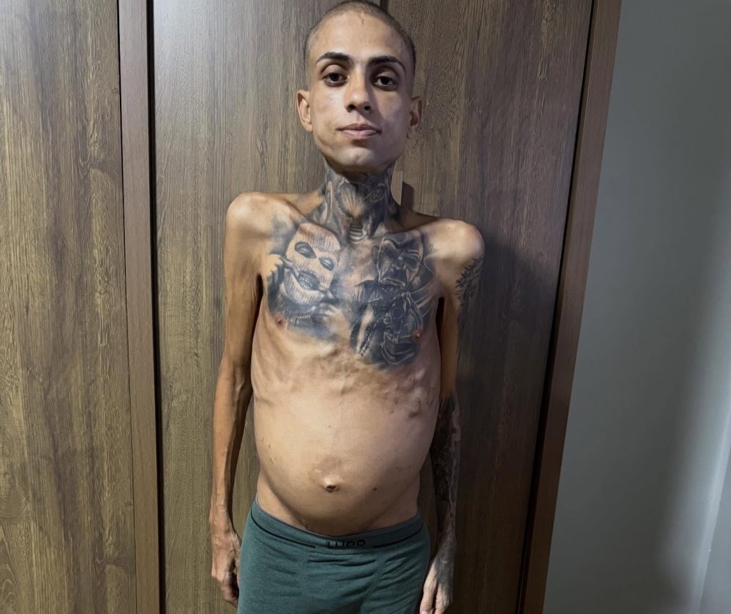 Young influencer Jota Surfista reveals devastating cancer, cirrhosis and thrombosis diagnosis caused by years of alcohol and drug abuse - now warning others to change their ways.