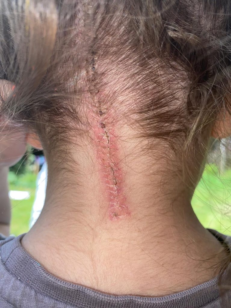 Mum's heart feels ripped out as 6-year-old Olivia's brain cancer returns terminal just 3 months after being cleared. Family desperately fundraising for US trial.