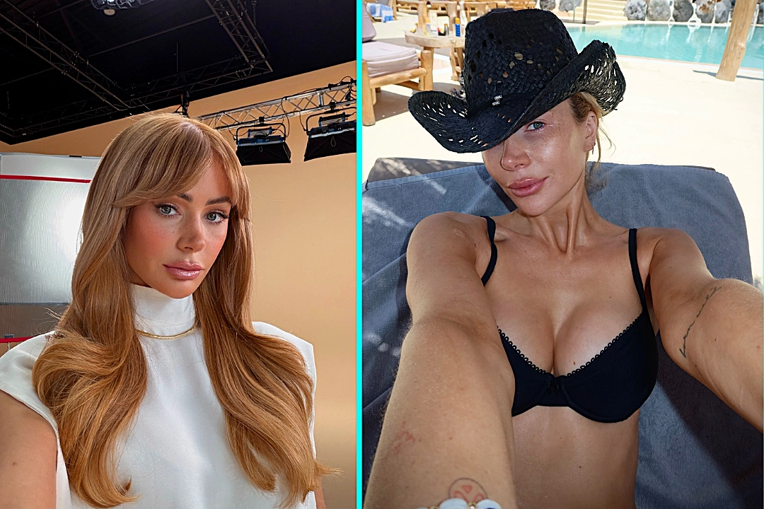 Love Island's Olivia Attwood had to wear shorts on the show after being stung on her genitals by a jellyfish in Mallorca, causing a severe reaction before entering the villa.